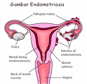 Obat Penyakit Kista Endometriosis
